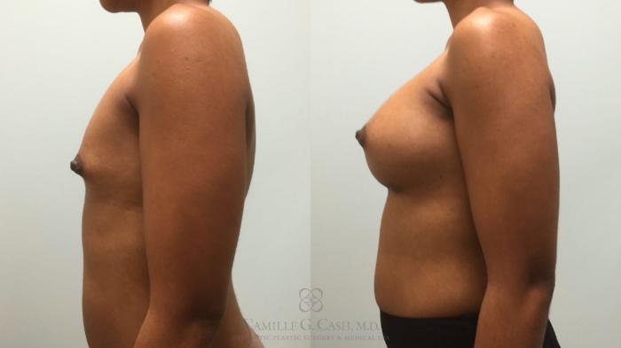 Before & After Breast Augmentation Case 579 Right Side View in Houston, TX