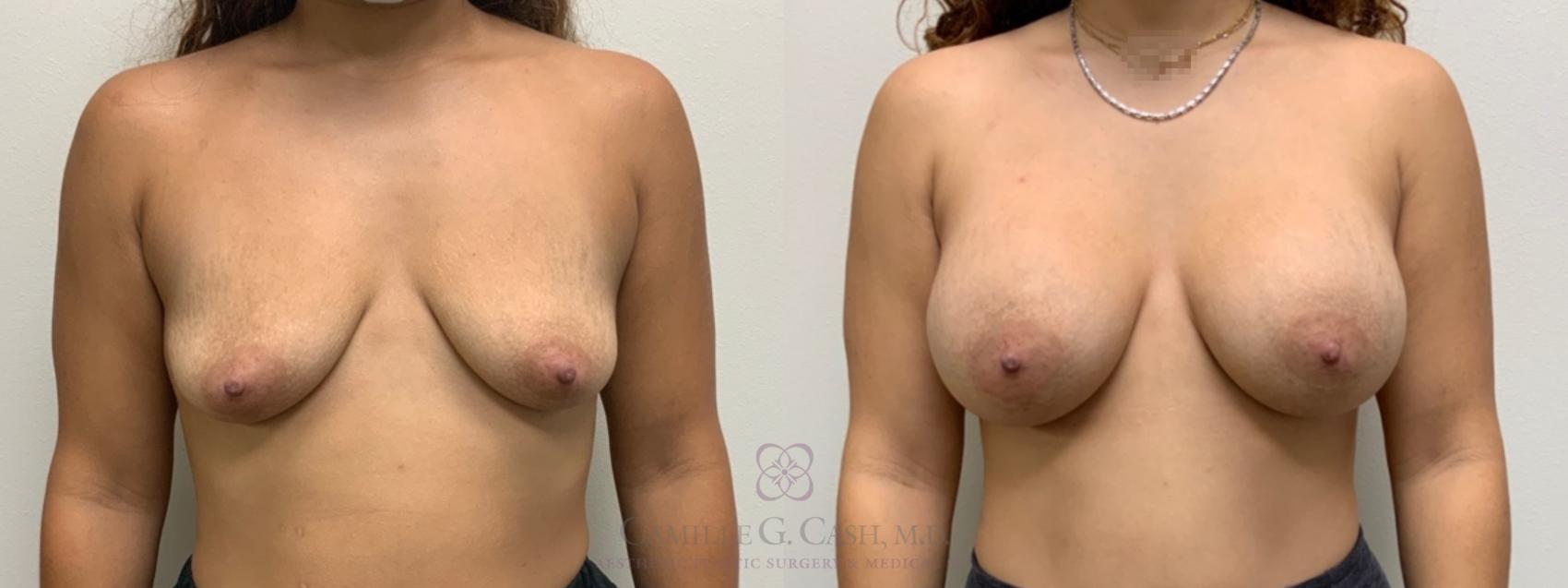 Before & After Breast Augmentation Case 586 Front View in Houston, TX