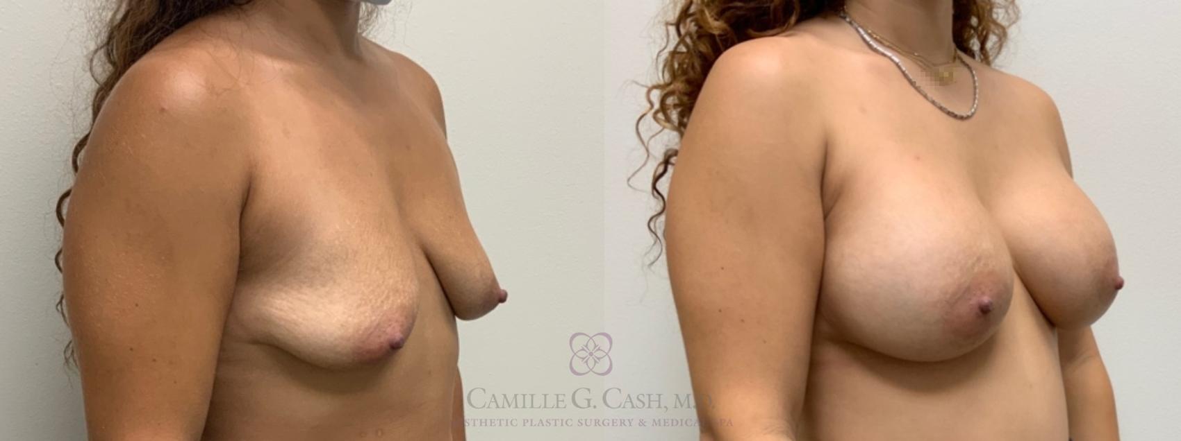 Before & After Breast Augmentation Case 586 Left Oblique View in Houston, TX