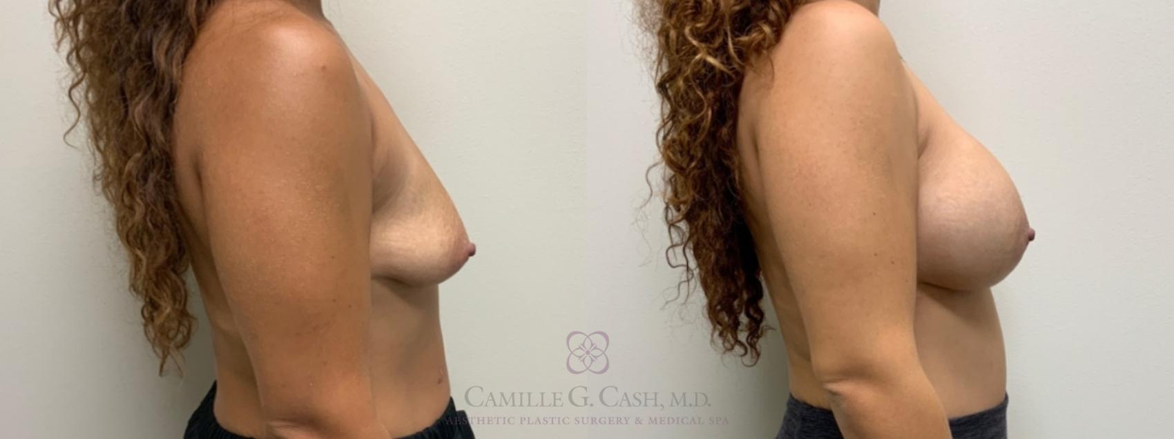 Before & After Breast Augmentation Case 586 Left Side View in Houston, TX