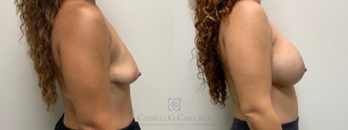 Before & After Post-Weight Loss Breast Enhancement Case 586 Left Side View in Houston, TX