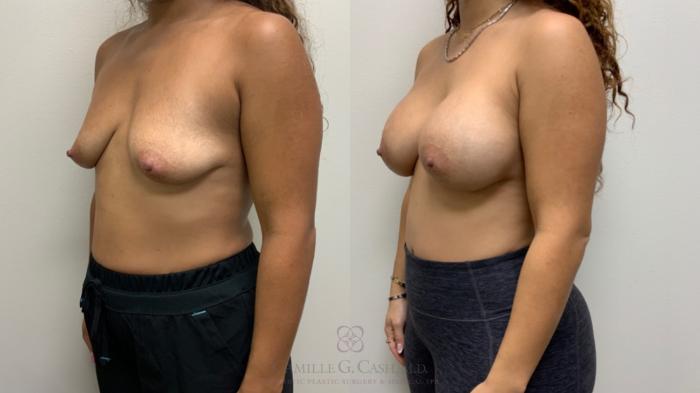 Before & After Post-Weight Loss Breast Enhancement Case 586 Right Oblique View in Houston, TX