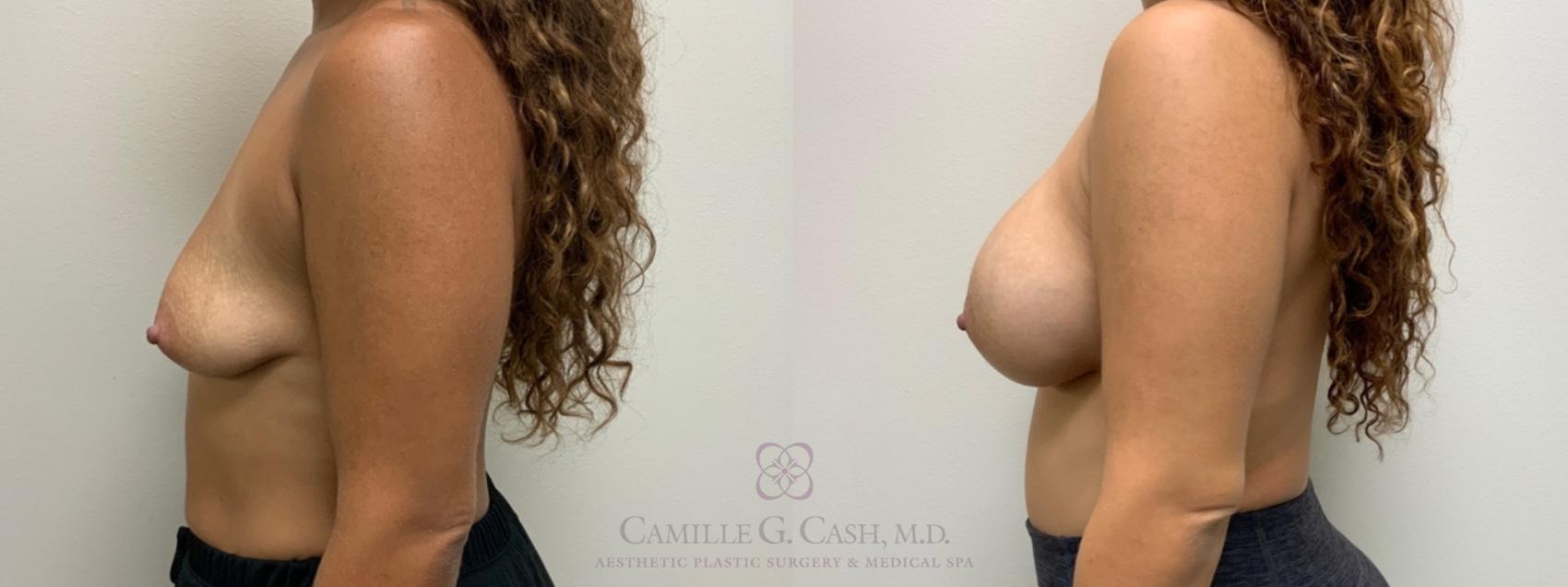 Before & After Breast Augmentation Case 586 Right Side View in Houston, TX