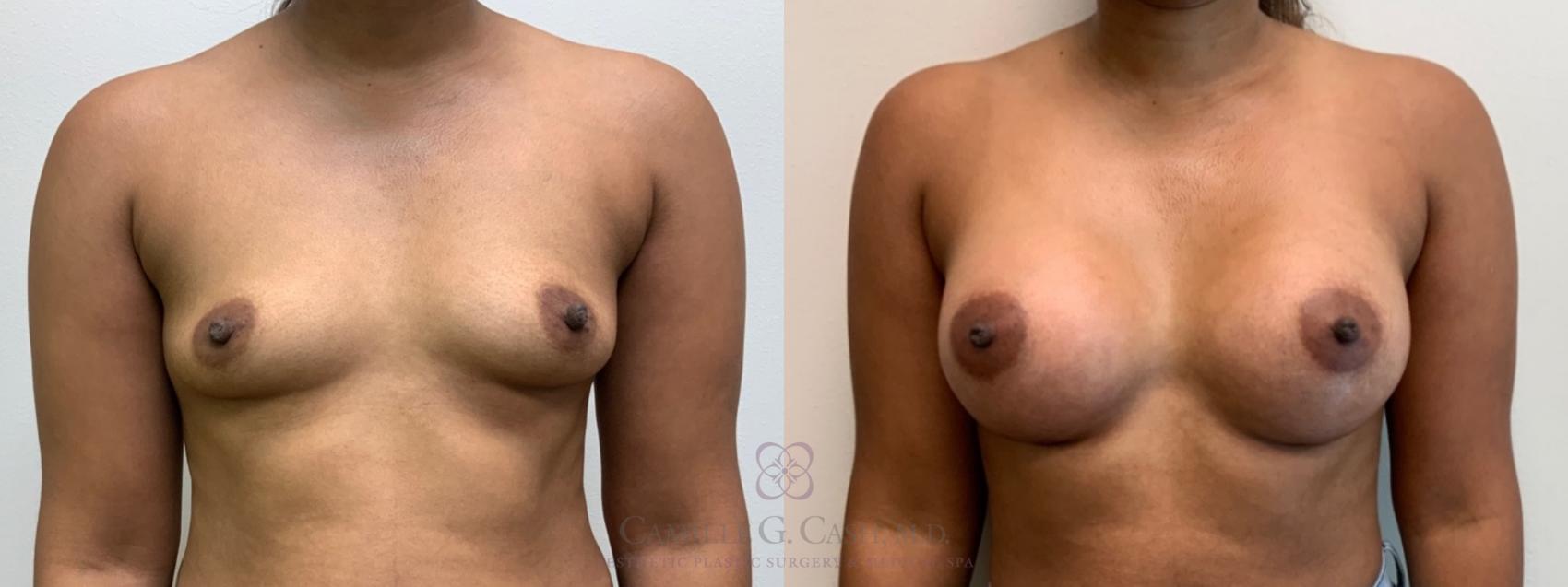 Before & After Breast Augmentation Case 587 Front View in Houston, TX