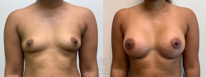 Before & After Breast Augmentation Case 587 Front View in Houston, TX