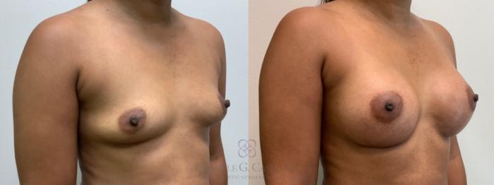 Before & After Breast Augmentation Case 587 Left Oblique View in Houston, TX