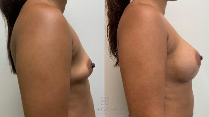 Before & After Breast Augmentation Case 587 Left Side View in Houston, TX