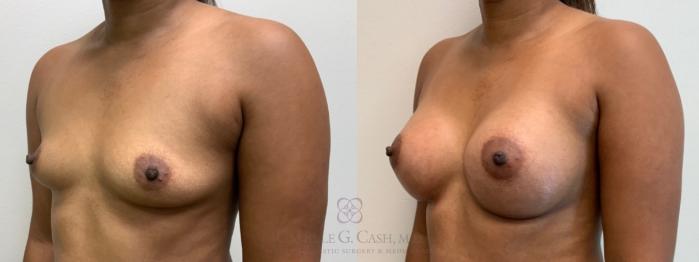 Before & After Breast Augmentation Case 587 Right Oblique View in Houston, TX