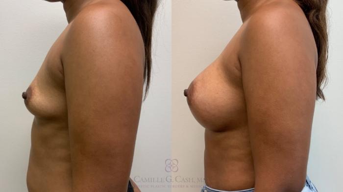 Before & After Breast Augmentation Case 587 Right Side View in Houston, TX
