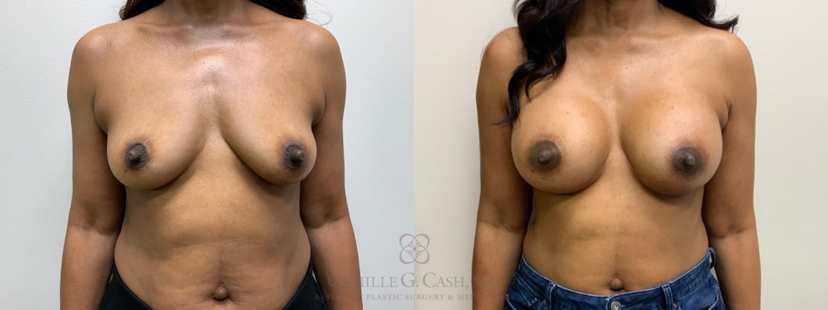 Before & After Breast Augmentation Case 588 Front View in Houston, TX