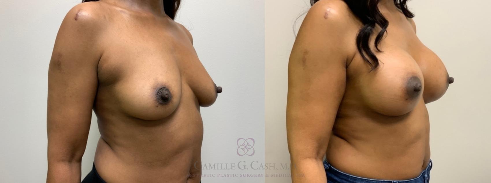 Before & After Breast Augmentation Case 588 Left Oblique View in Houston, TX