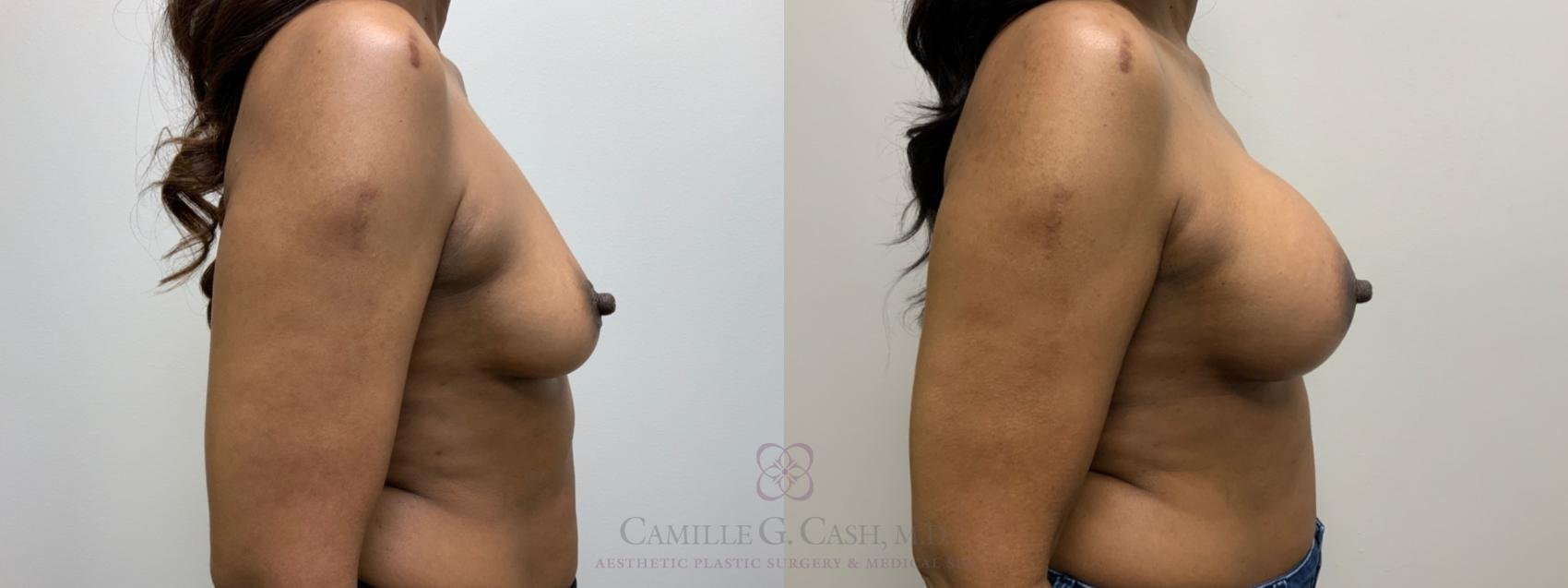 Before & After Breast Augmentation Case 588 Left Side View in Houston, TX