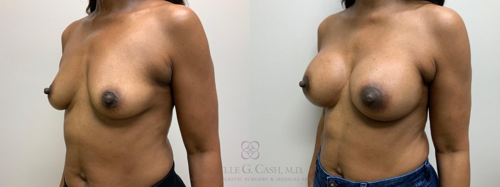 Before & After Breast Augmentation Case 588 Right Oblique View in Houston, TX