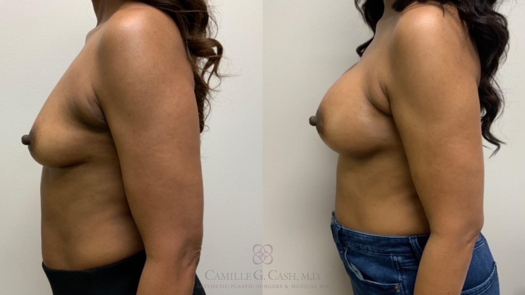 Before & After Breast Augmentation Case 588 Right Side View in Houston, TX