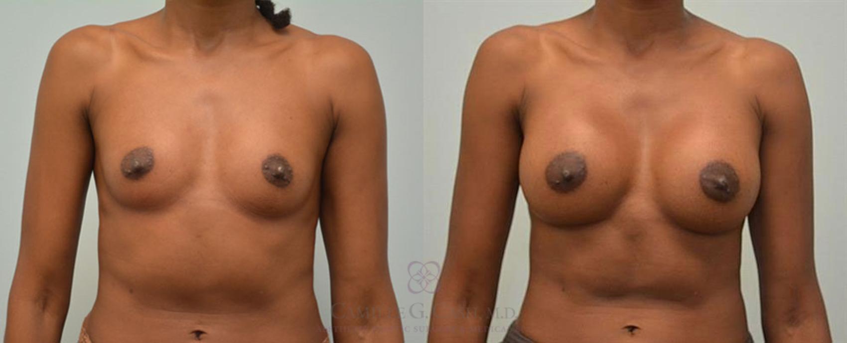Before & After Breast Augmentation Case 59 View #1 View in Houston, TX