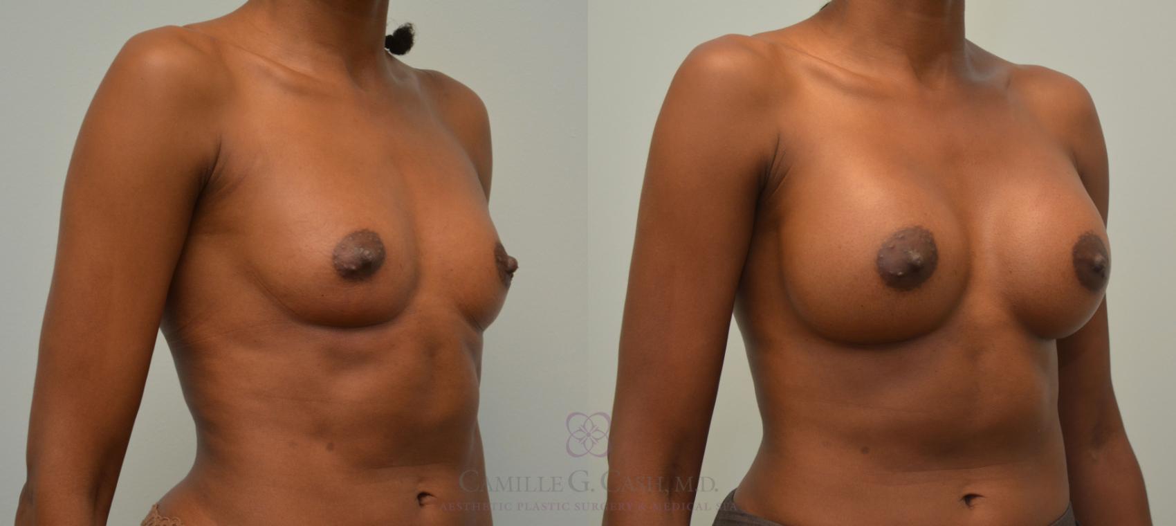 Before & After Breast Augmentation Case 59 View #2 View in Houston, TX