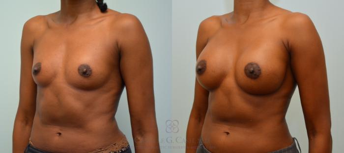 Before & After Breast Augmentation Case 59 View #3 View in Houston, TX