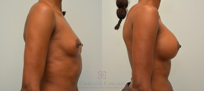 Before & After Breast Augmentation Case 59 View #4 View in Houston, TX