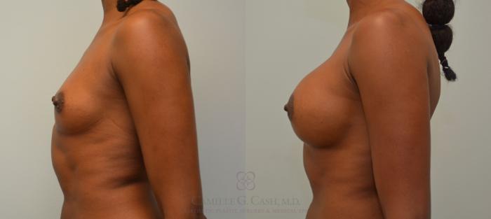 Before & After Breast Augmentation Case 59 View #5 View in Houston, TX
