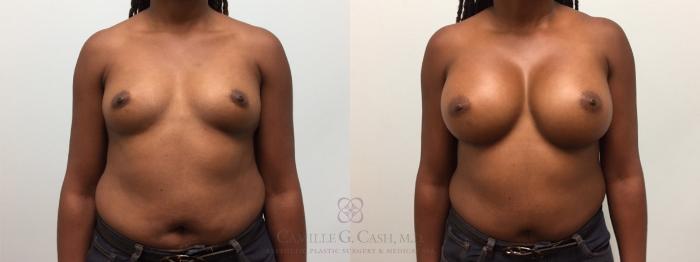 Before & After Breast Augmentation Case 601 Front View in Houston, TX