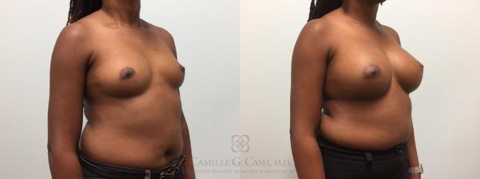 Before & After Breast Augmentation Case 601 Left Oblique View in Houston, TX