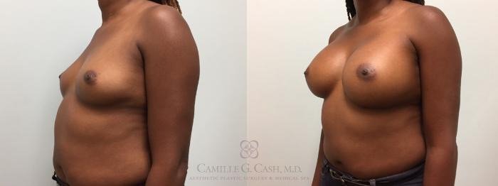 Before & After Breast Augmentation Case 601 Right Oblique View in Houston, TX
