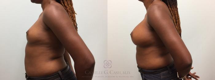 Before & After Breast Augmentation Case 601 Right Side View in Houston, TX