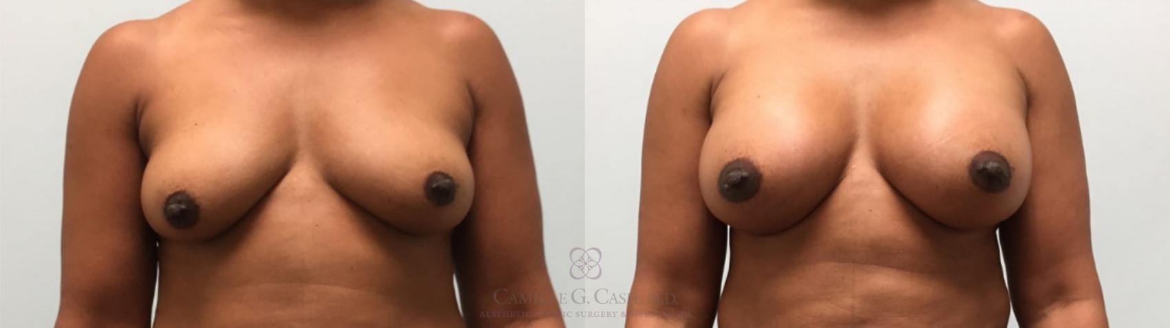 Before & After Breast Augmentation Case 604 Front View in Houston, TX
