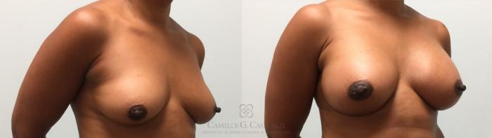 Before & After Breast Augmentation Case 604 Left Oblique View in Houston, TX