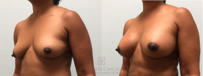 Before & After Breast Augmentation Case 604 Right Oblique View in Houston, TX
