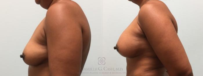 Before & After Breast Augmentation Case 604 Right Side View in Houston, TX