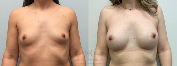 Before & After Breast Augmentation Case 605 Front View in Houston, TX