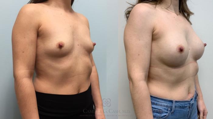 Before & After Breast Augmentation Case 605 Left Oblique View in Houston, TX