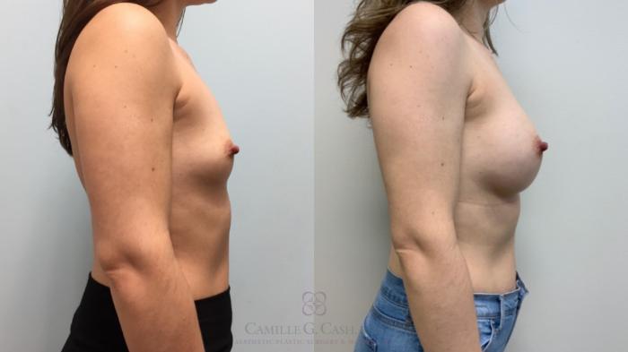 Before & After Breast Augmentation Case 605 Left Side View in Houston, TX