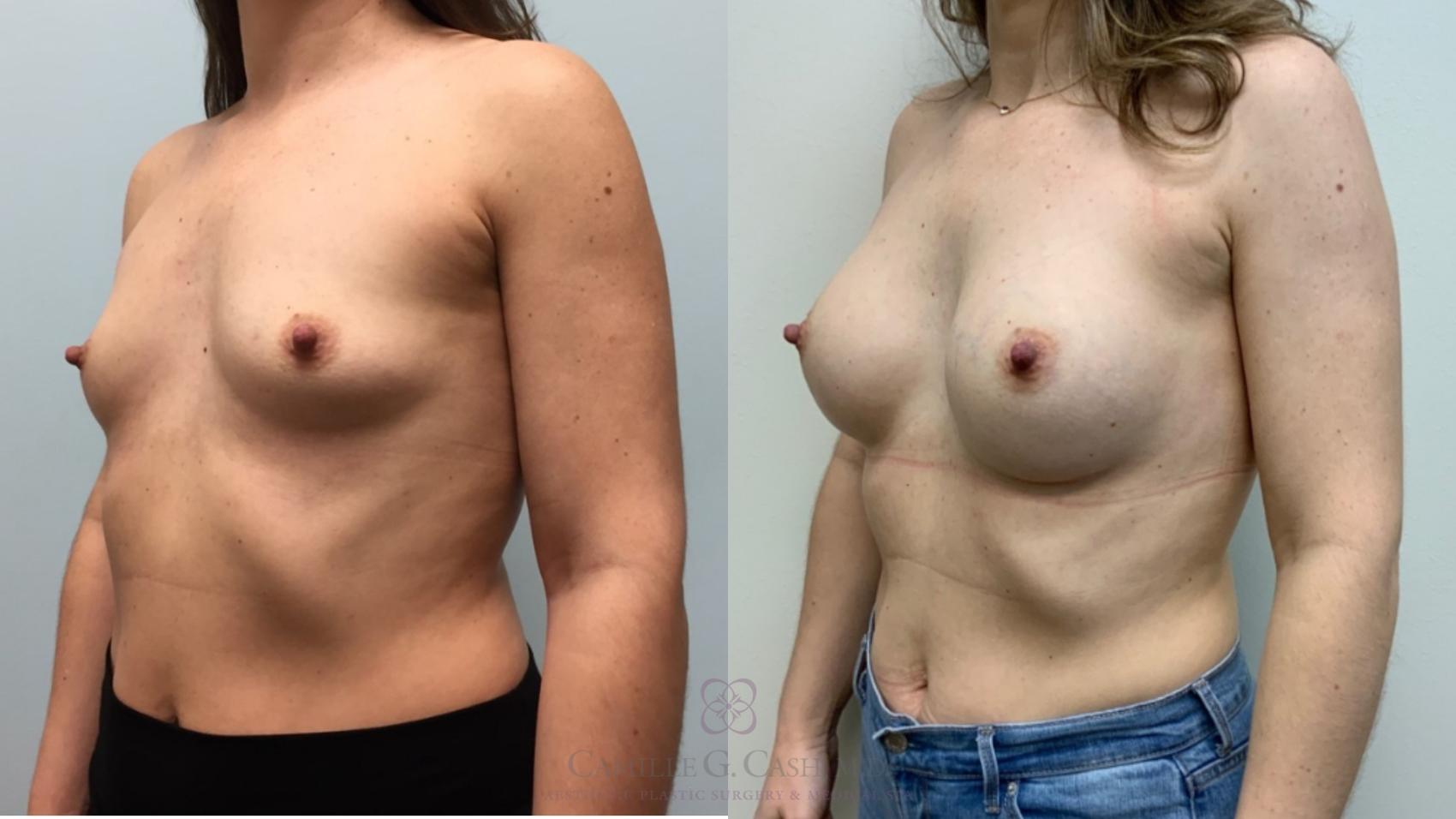 Before & After Breast Augmentation Case 605 Right Oblique View in Houston, TX