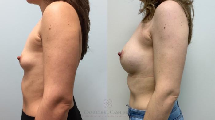 Before & After Breast Augmentation Case 605 Right Side View in Houston, TX