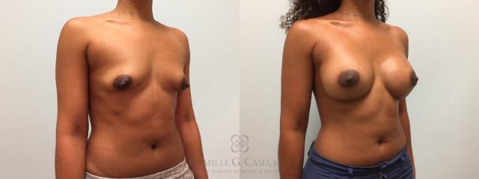 Before & After Breast Augmentation Case 606 Left Oblique View in Houston, TX