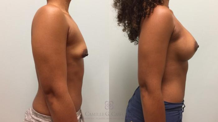 Before & After Breast Augmentation Case 606 Left Side View in Houston, TX