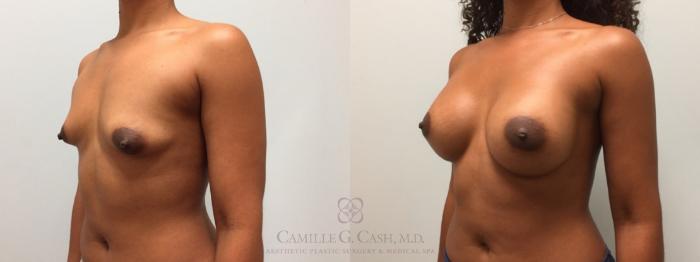 Before & After Breast Augmentation Case 606 Right Oblique View in Houston, TX