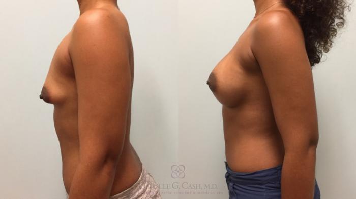 Before & After Breast Augmentation Case 606 Right Side View in Houston, TX