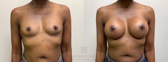 Before & After Breast Augmentation Case 611 Front View in Houston, TX