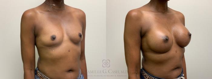 Before & After Breast Augmentation Case 611 Left Oblique View in Houston, TX