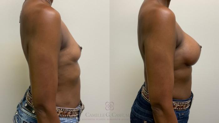 Before & After Breast Augmentation Case 611 Left Side View in Houston, TX