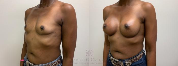Before & After Breast Augmentation Case 611 Right Oblique View in Houston, TX