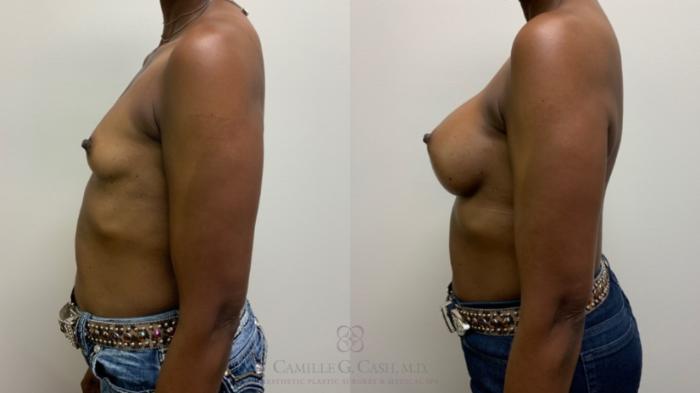 Before & After Breast Augmentation Case 611 Right Side View in Houston, TX