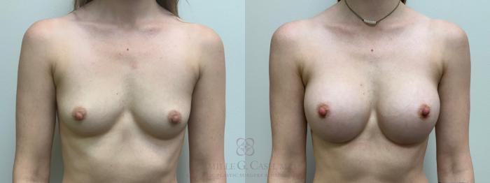 Before & After Breast Augmentation Case 612 Front View in Houston, TX