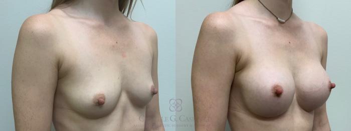 Before & After Breast Augmentation Case 612 Left Oblique View in Houston, TX
