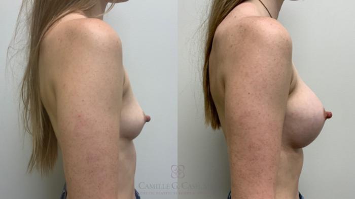 Before & After Breast Augmentation Case 612 Left Side View in Houston, TX