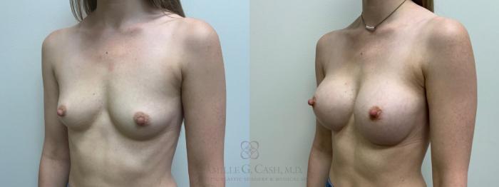 Before & After Breast Augmentation Case 612 Right Oblique View in Houston, TX
