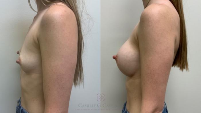 Before & After Breast Augmentation Case 612 Right Side View in Houston, TX